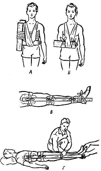 Рис. 2. Различные способы наложения шин: А - при переломе плеча; Б - при переломе предплечья; В - при переломе голени; Г - при переломе бедра