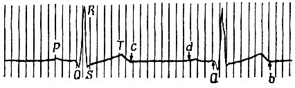 Нормальная электрокардиограмма: зубцы - Р, Q, R, S и Т; аb - электрическая систола сердца (Q R S Т); cd - диастола сердца (ТР)